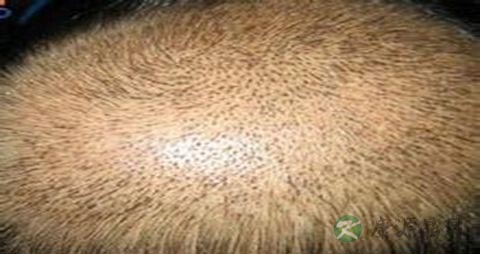 中医能治疗脱发吗