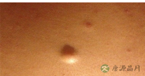 皮下囊肿怎么治疗 皮下囊肿怎么治疗