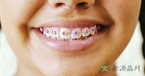 牙齿矫正 吃什么