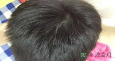 怎么治疗脱发和掉发