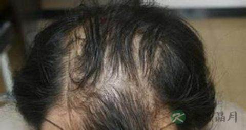 男人脱发用什么