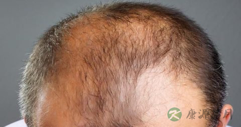 雄性脱发怎么治疗