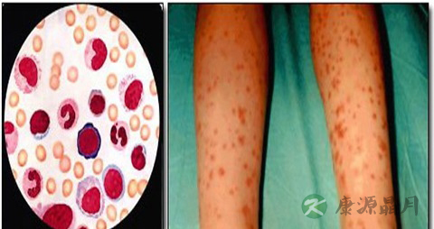 骨髓增生异常综合症饮食