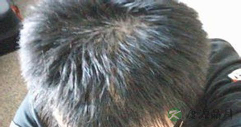 肾虚脱发怎么治疗