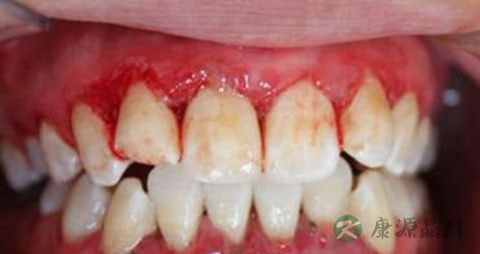 牙龈流血吃什么