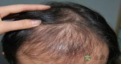 中医治疗脱发有效果吗
