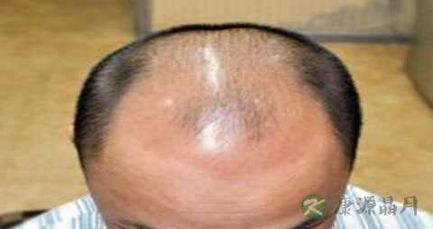 男人脂溢性脱发怎么办