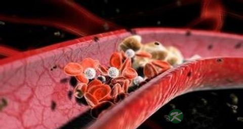 深静脉血栓吃什么好