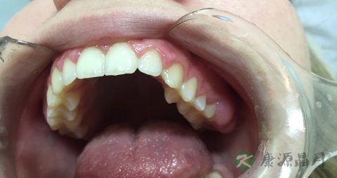 牙龈溃烂吃什么药