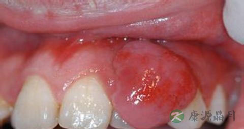 牙龈肿痛 吃什么