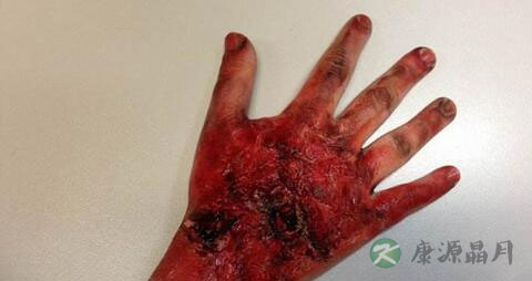 烧伤级别有哪些