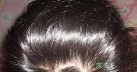 压力大脱发怎么办