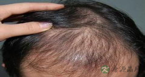 男人脱发是怎么回事