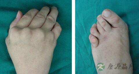 类风湿什么不能吃