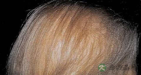 雄性脱发的症状