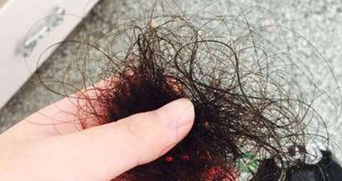 脱发是怎么回事