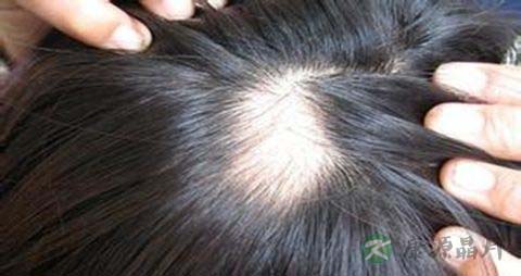 有什么可以治疗脱发
