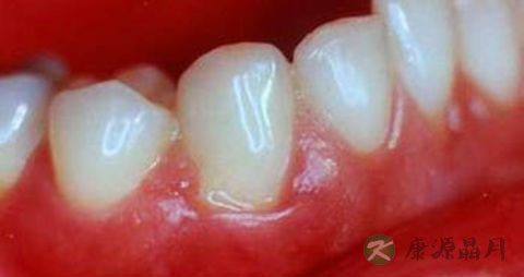 牙龈发炎吃什么食物