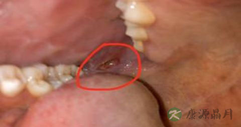 牙龈溃疡吃什么