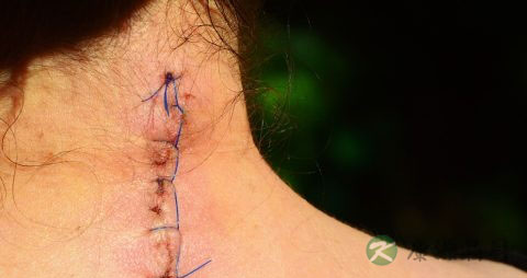 伤口愈合吃什么