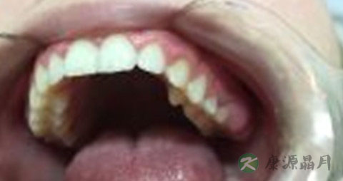 牙槽骨矫正多少钱