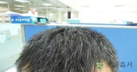 遗传性脱发有治吗