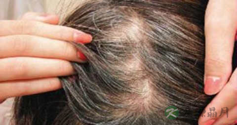 有什么办法治疗脱发