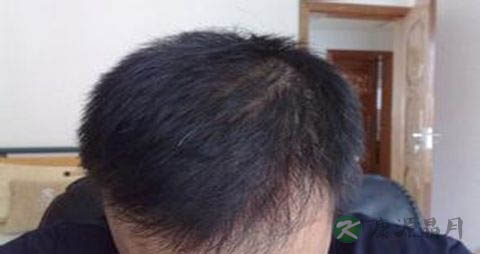 脱发是由什么引起的