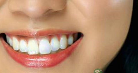 镍铬烤瓷牙多少钱