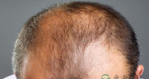 雄性脱发怎么办