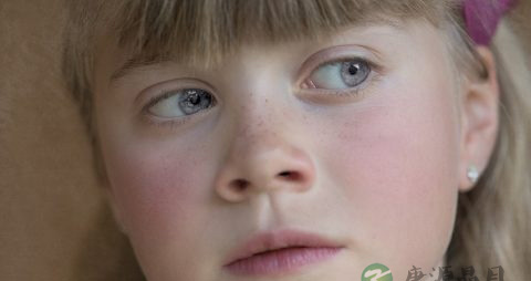 改善红血丝的方法