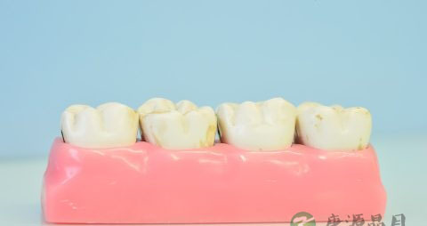 烤瓷牙的材料