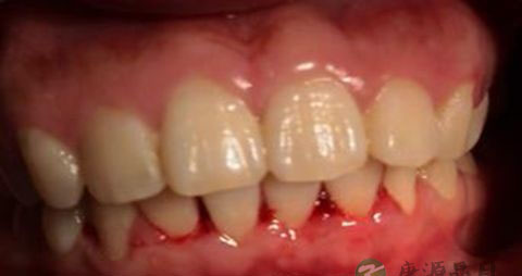 牙龈出血吃什么水果