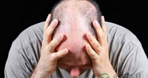 肝火旺会脱发吗