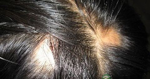 感染性脱发症状