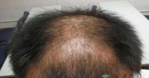 遗传性脱发怎样治疗