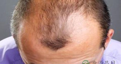 油脂性脱发如何治疗