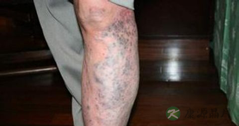 腿部血栓病人吃什么好