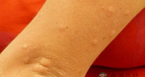 肛门痛痒怎么办