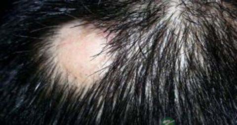 头上脱发怎么办