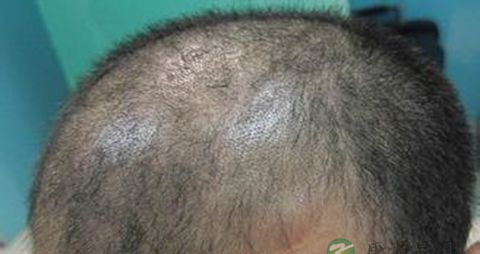 油脂性脱发怎么治