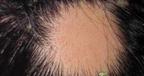 突然脱发严重什么原因