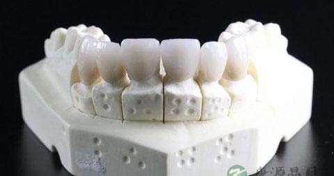 戴牙套要多少钱