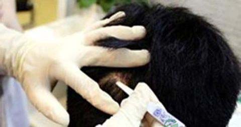 男人脂溢性脱发怎么办