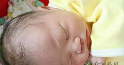 孩子脱发是缺什么