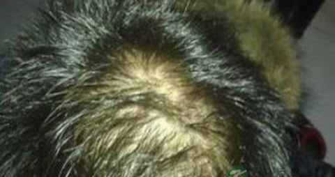 脂溢性脱发特征