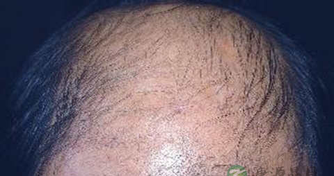 脂溢性脱发有哪些症状