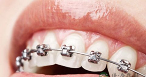 牙齿矫正期间饮食