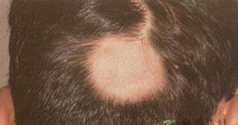 头上脱发怎么回事