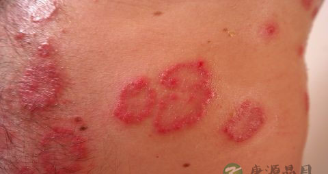 皮下囊肿怎么治疗 皮下囊肿怎么治疗